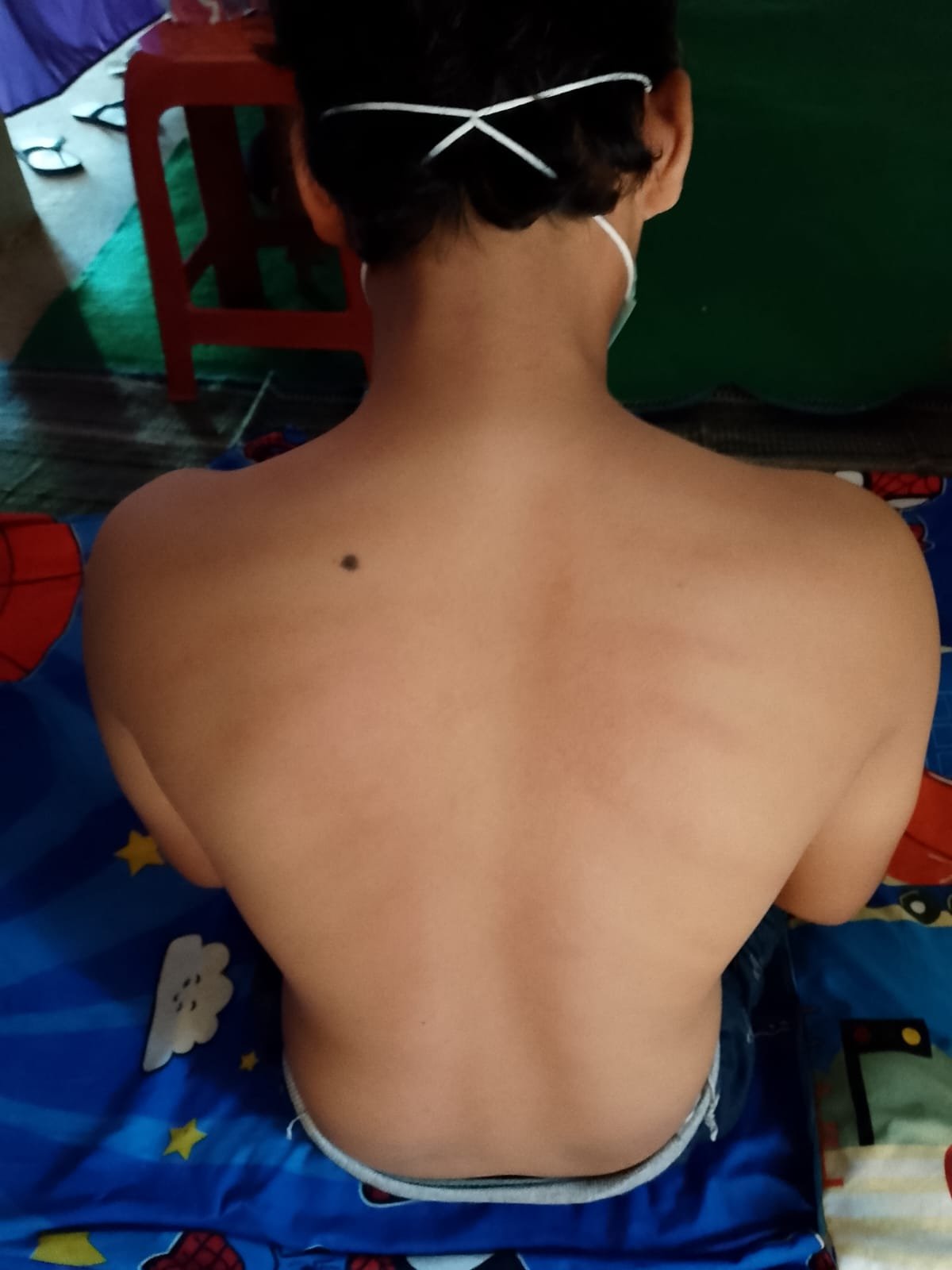 Punggung pasien setelah mengikuti sesi terapi